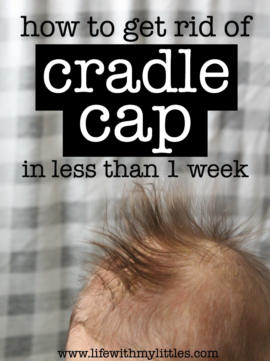 How to Get Rid of Cradle Cap